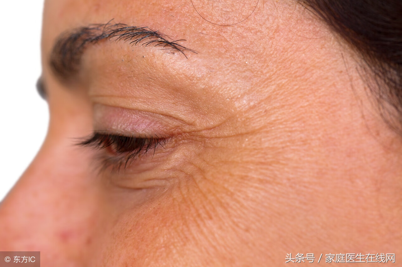 去鱼尾纹有效的方法(鱼尾纹严重用什么最有效)
