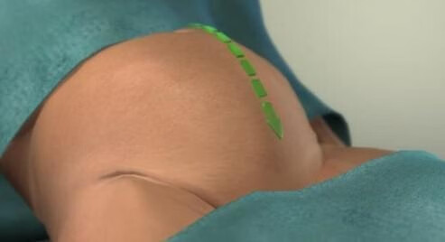 剖腹产过程及步骤组图(剖腹产的真实过程)