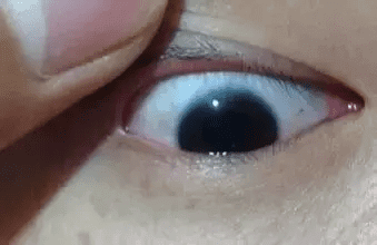 老人眼珠发黄怎么回事(眼珠有点黄是什么原因怎么办)