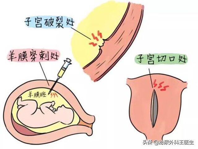 切除子宫 影响(子宫切除会影响什么)
