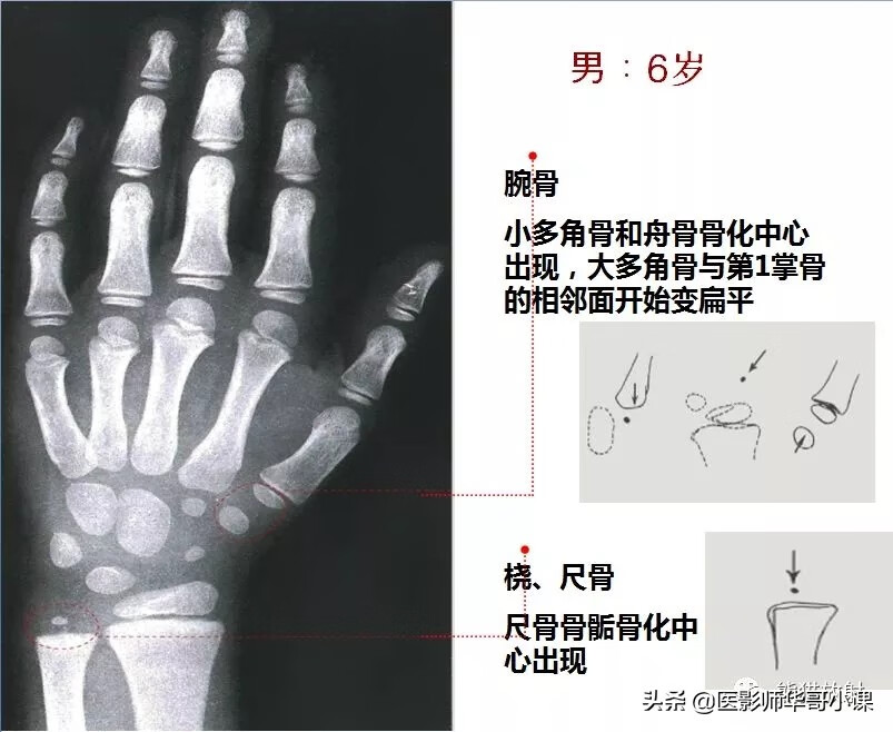 怎样测骨龄?(测骨龄的最佳年龄)