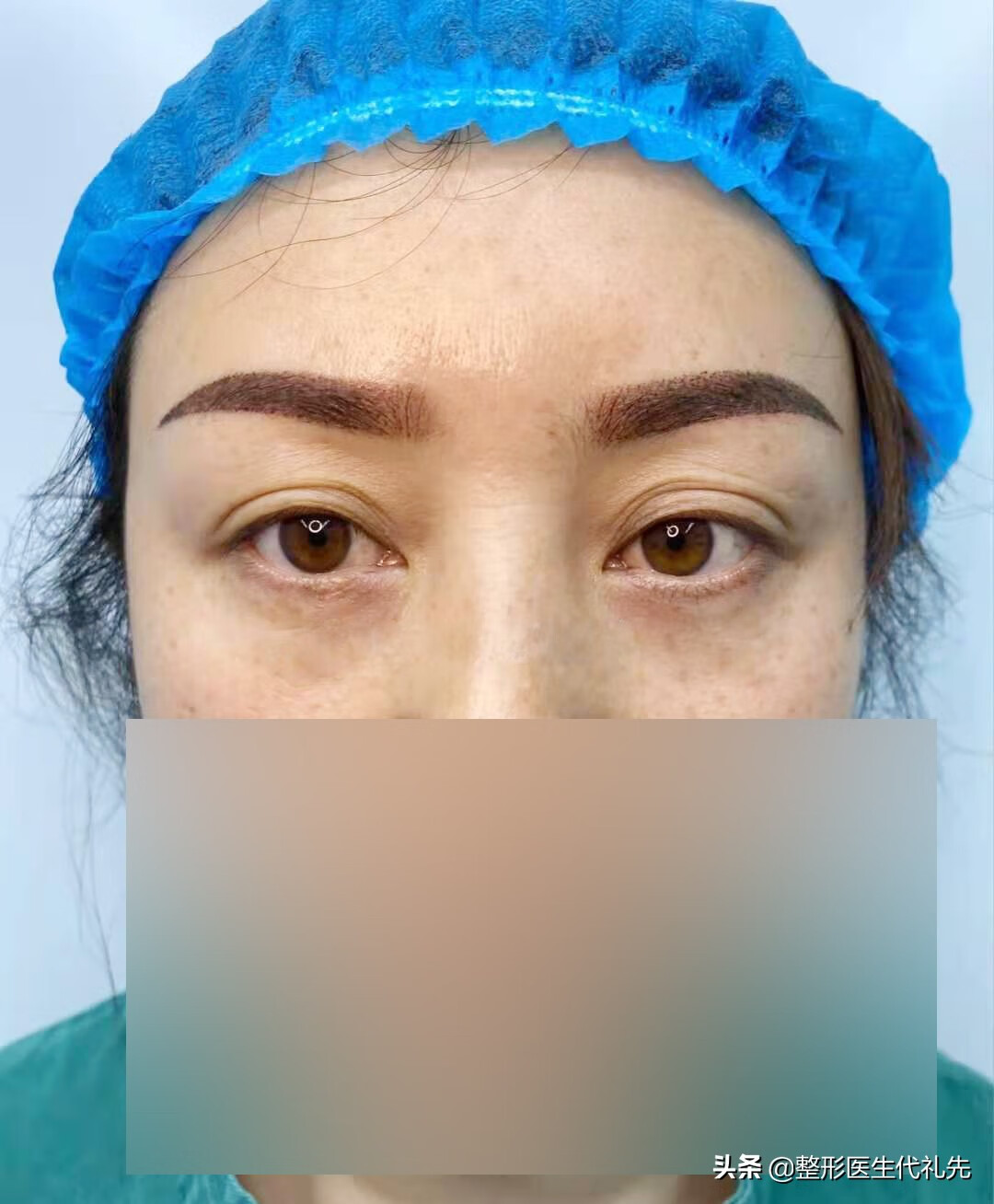 割双眼皮手术效果如何(割双眼皮有风险吗?)