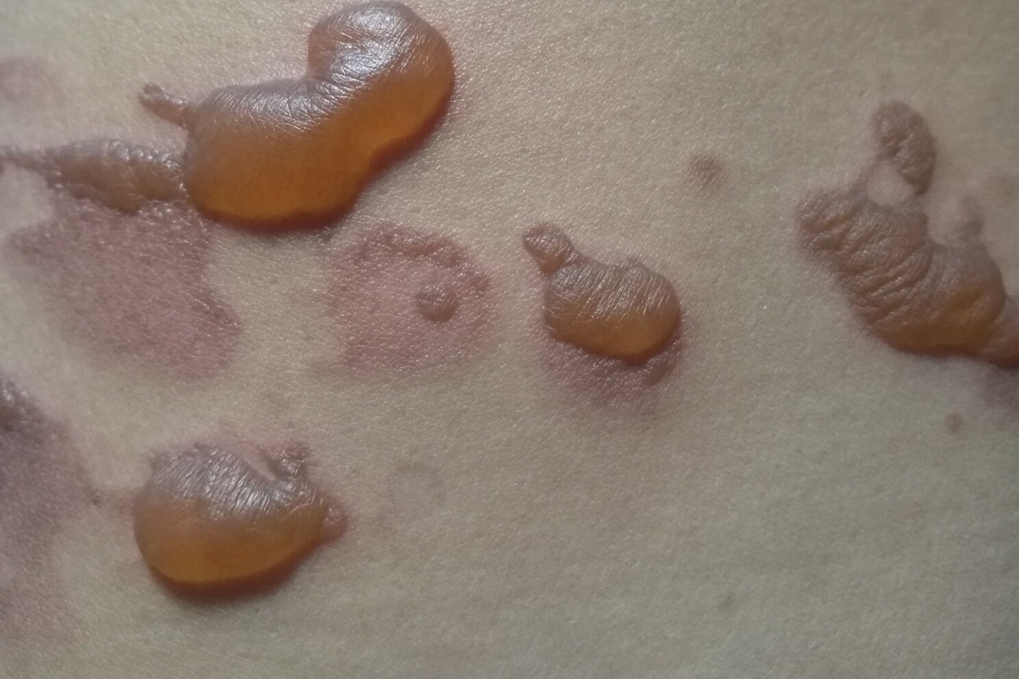 烫伤吃什么好点(烧伤烫伤吃什么好得快)