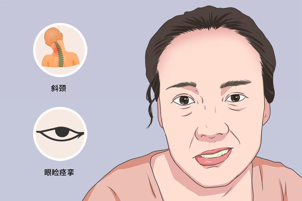 多系统萎缩症是什么病(多系统萎缩的病因)