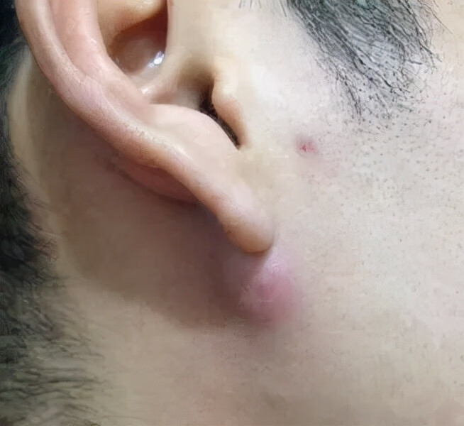 疖肿图片(什么样的人容易得疖肿)