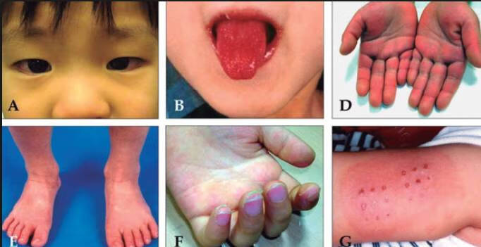 儿童湿疹的症状图片(儿童脸上长湿疹图片)