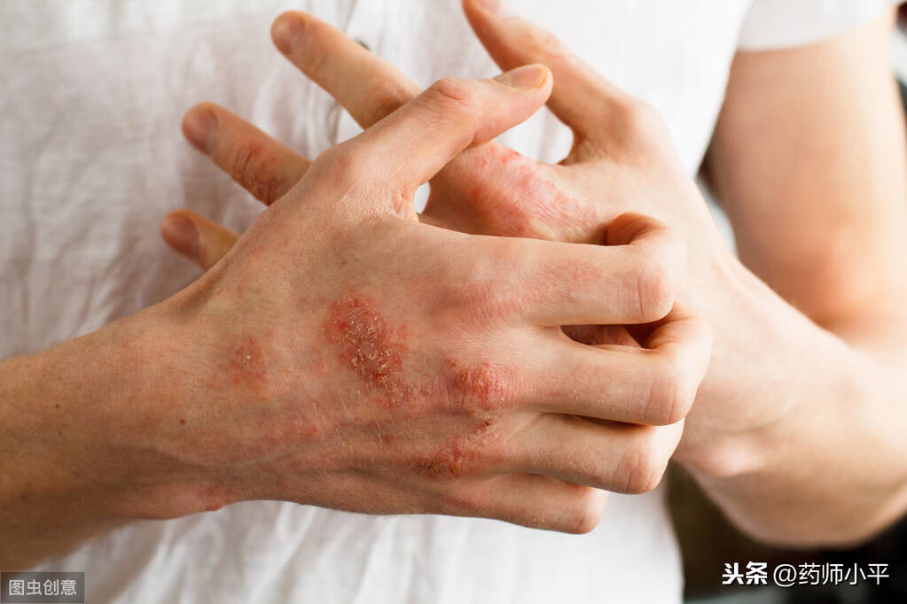 手指湿疹最佳治疗方法寻(手部湿疹最佳治疗方法)