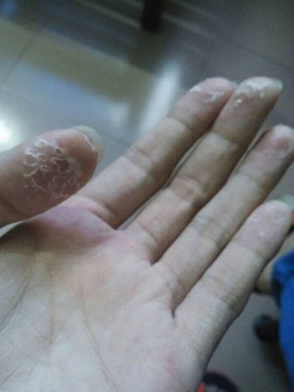 手指脱皮是咋回事(手指脱皮的原因)
