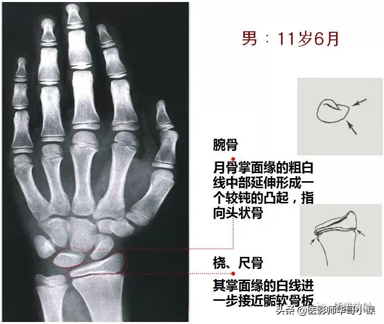 怎样测骨龄?(测骨龄的最佳年龄)