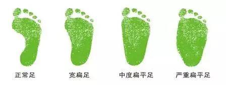 什么是扁平足?(扁平足是什么样)