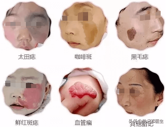 胎记的价格?(胎记多少钱)
