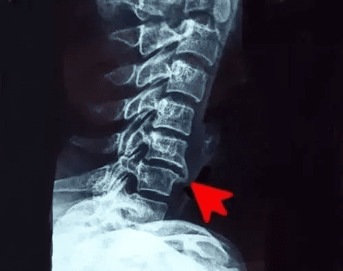 骨刺怎么治疗最好(百度骨刺怎么治疗)