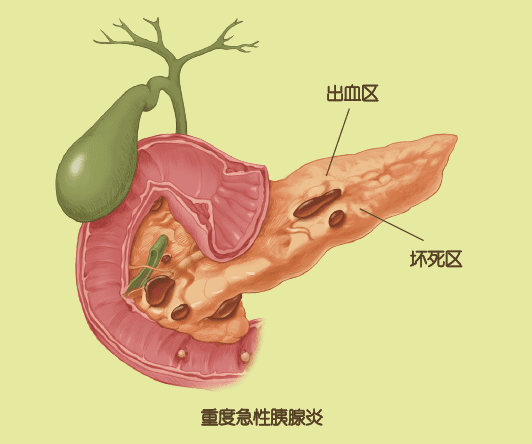 急性胰腺炎能治好吗(胰腺炎能彻底根治吗)