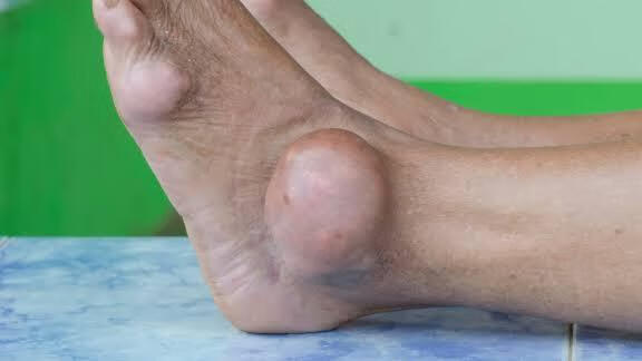 一只脚踝肿是怎么回事女性脚踝肿是什么原因引起的