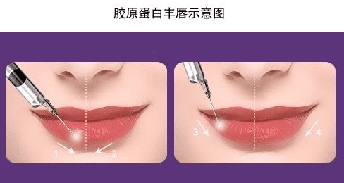 胶原蛋白丰唇效果怎么样(胶原蛋白肽可以丰胸吗)