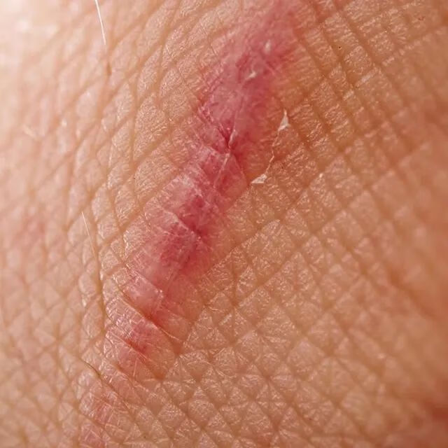 剖腹产的疤痕是什么样子的(剖腹产肚子疤痕)