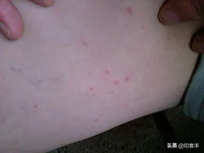什么是风疹的症状(风疹是怎么引起的)