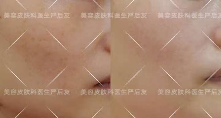 色斑的治疗(激光祛斑的费用大概多少)