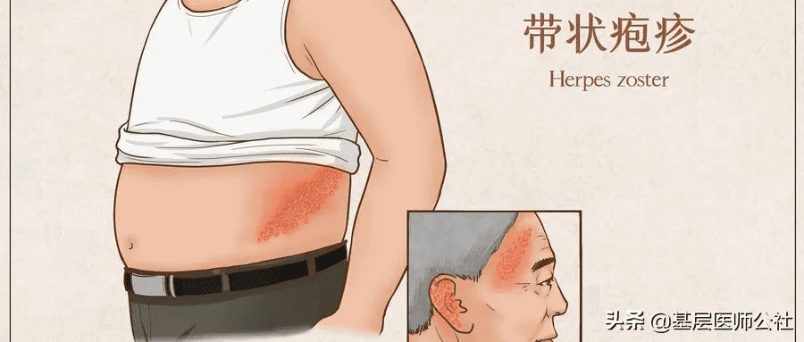 疱疹病毒感染图片(病毒性疱疹)