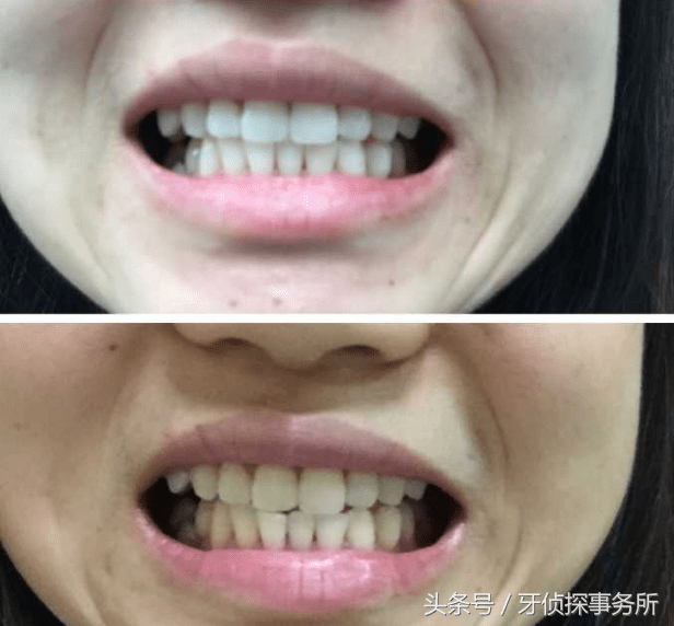 冷光牙齿美白原理(冷光美白对牙齿有伤害吗)