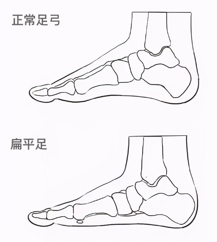 扁平足圖片扁平足特徵圖片