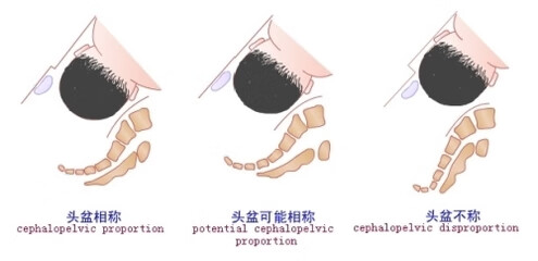 孕妇难产是什么原因引起的(孕妇难产怎么办)
