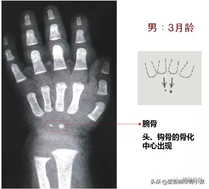 怎样测骨龄?(测骨龄的最佳年龄)