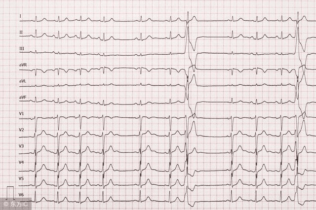 房颤心电图 正常图片