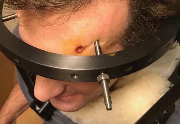 额头上有个骨头包(额头长硬包跟骨头一样)