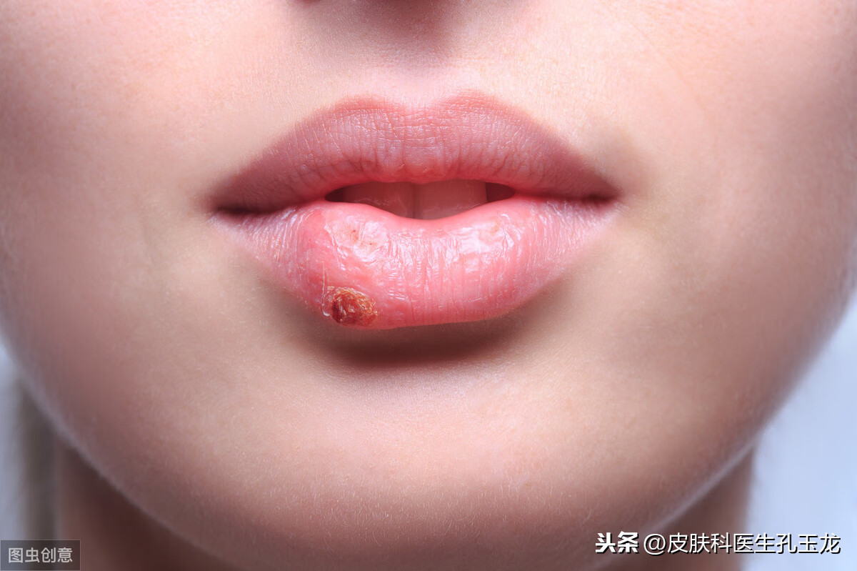 嘴唇上火怎么办(嘴巴里面上火怎么办)