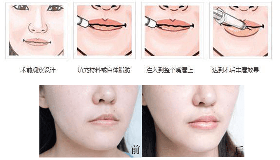 胶原蛋白丰唇效果怎么样(胶原蛋白肽可以丰胸吗)