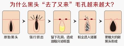 草莓鼻子是怎么形成的