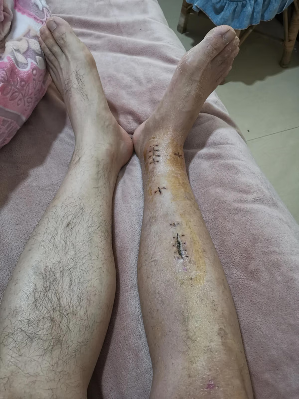 双腿胫腓骨骨折风水(小腿胫腓骨骨折)