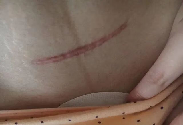 剖腹产的疤痕是什么样子的(剖腹产肚子疤痕)