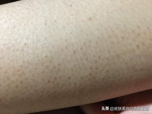 鸡皮肤用什么药最有效(鸡皮肤擦什么药好)