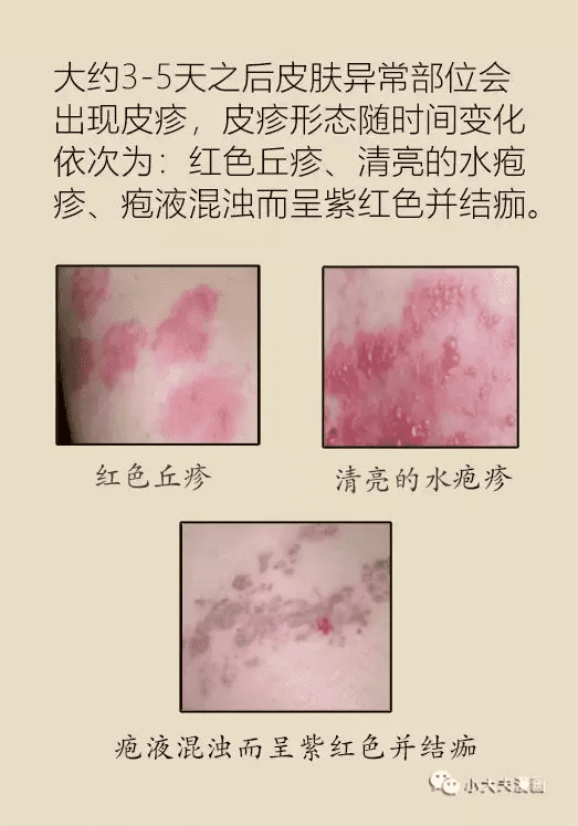 治疗泡诊那个医院好(治疗疱疹的药膏)