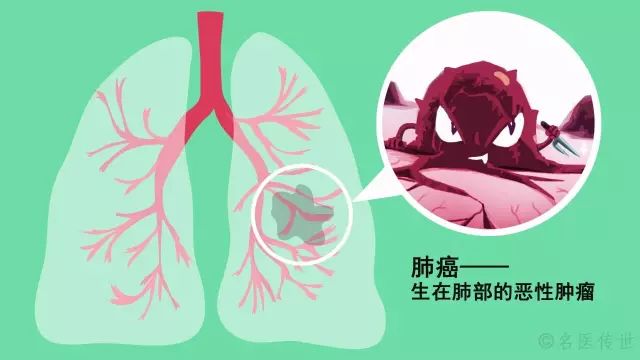 早期肺癌有传染吗(肺癌传不传染?要注意些什么)