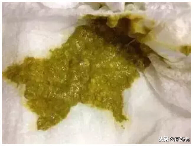 宝宝大便发绿是怎么回事(2个月宝宝大便发绿)