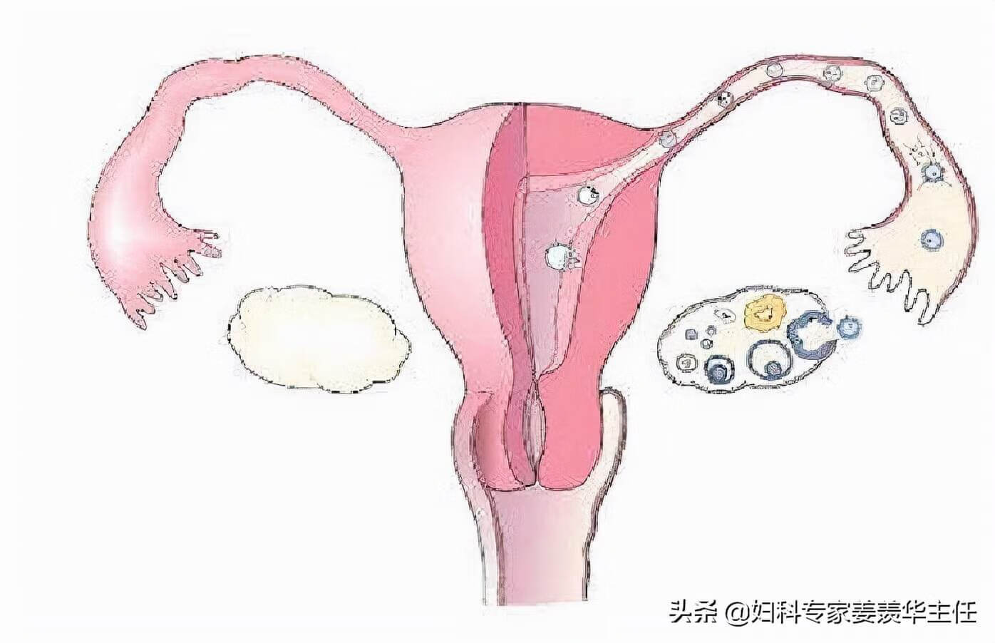 子宫切除后注意事项有哪些(子宫全切手术后注意事项)