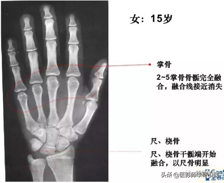 怎样测骨龄?(测骨龄的最佳年龄)