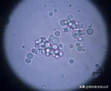前列腺钙化灶是什么意思(前列腺钙化灶是什么原因)