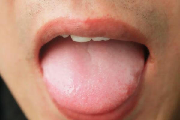 舌苔很白很白是什么原因(舌苔发白喝什么除湿气)