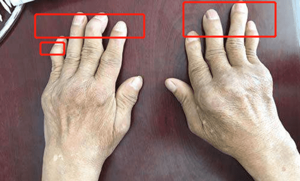 最近手关节痛是怎么回事手关节痛怎么治