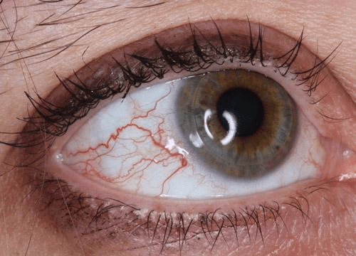 白眼球有红血丝正常吗白眼球长期有红血丝是什么原因