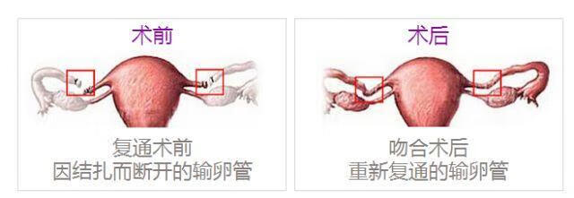 输卵管复通手术全过程(输卵管复通的手术步骤)