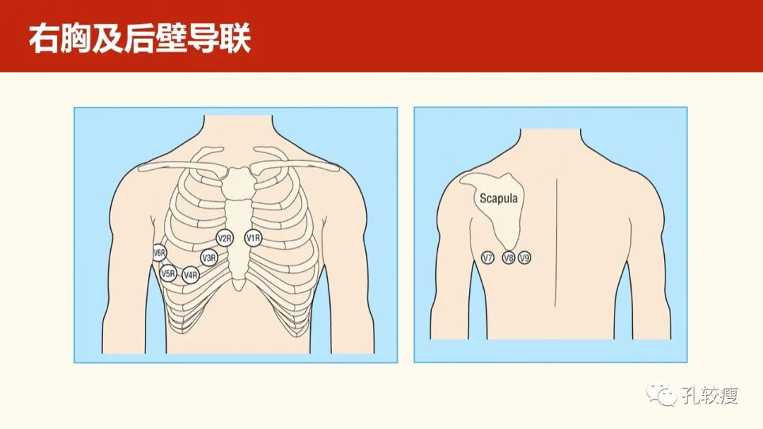 心电图导联位置示意图(心电图机导联位置图)