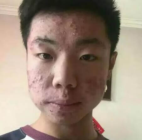 青春期痤疮一般到什么年龄结束(青春期痘痘一般几年)