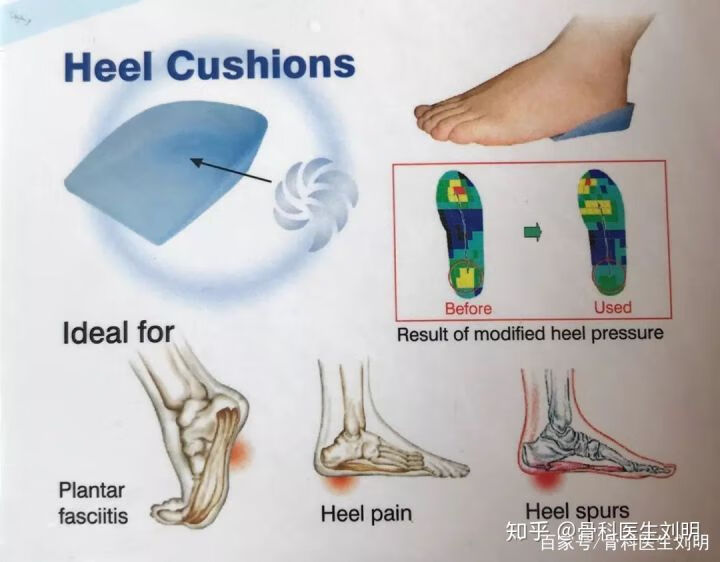 足跟痛专用贴(足跟痛贴哪里有卖)
