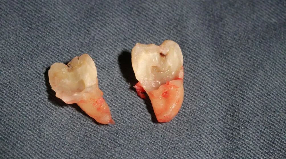 低位阻生(牙根靠近下牙槽神经管)的智齿,甚至拔到最后牙齿都留不