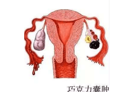右附件囊肿怎么引起的(右侧附件囊肿怎么引起的)